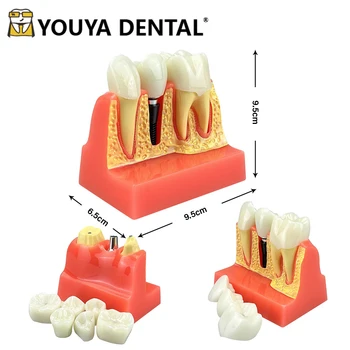 Модел на обучение на студентите-стоматолози зъби на 4-кратна модел имплант за проучване на зъболекар, обучение, комуникация лекар и пациент